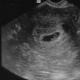 Drömtolkning Embryo I en dröm, se ett embryo, är ett barn vid liv